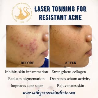 📞 9591 550 555

Laser tonning is a dermatological procedure helpful in improving your skin’s appear