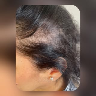 La alopecia no comienza de un día para otro.

Antes aparecen pequeños cambios que muchas personas pa