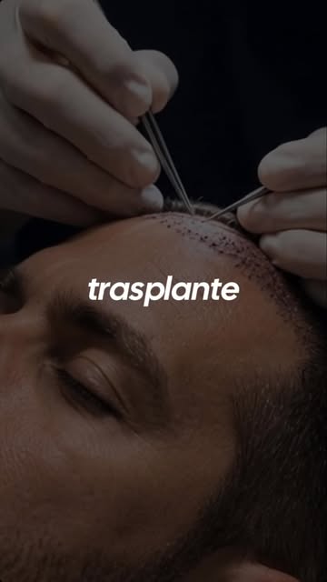 Menos improvisación. Más planificación. 🧠✨

En un trasplante capilar, cada folículo cuenta. No se t