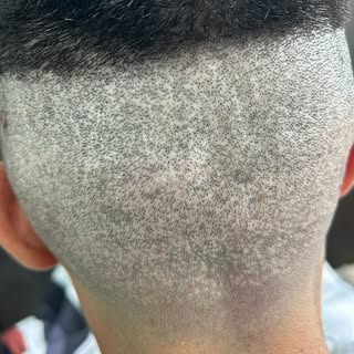 Micropigmentare scalp 
Constanța 
☎️ 0769887799
1st session after hair transplant scar cover 
#micro