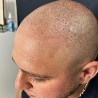 Soft first session on really blonde hair, i love the outcome, client really happy, he was so nervous