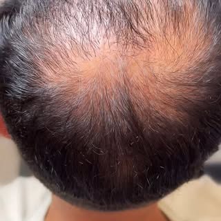 Density after hair transplant.
1st session on scalp micropigmentation. Very honoured to have people 