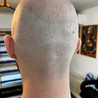 Scar cover smp 
#micropigmentareacalp #smp #scalpmicropigmentation #scarcover #hairtransplant
