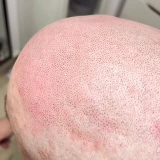 Micropigmentare scalp, prima ședință. 
Constanța, România 🇷🇴 
☎️0769887799
#constanta #romania #sm