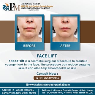 Transform your look with our expertly performed face-lift procedure. Say goodbye to sagging skin and