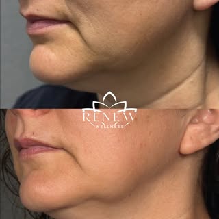 That jawline though. 😮‍💨

No surgery. No downtime. Just real, lifted skin.

This is lower face Ult