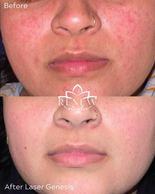 Rosacea, meet Laser Genesis.

Calms redness. 
Builds collagen. 
Smooths texture. 
Zero downtime.

Th