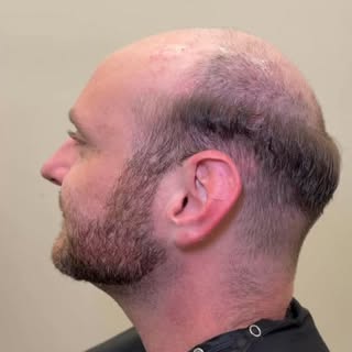 Check out this amazing before and after! He looks great either way, but with his hair system, you ca