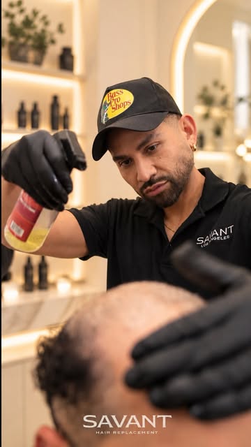 Our client started noticing his hair loss in college, and it took a toll on his confidence at a youn