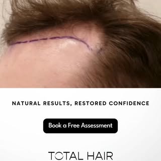 Natural results aren't about looking different. They're about looking like yourself again 💪

Restor