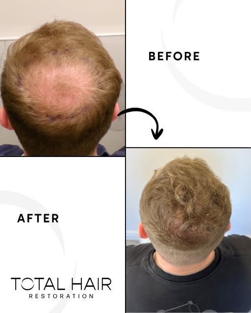 Every hair restoration journey is unique, and Darragh's results are a great example of what can be a
