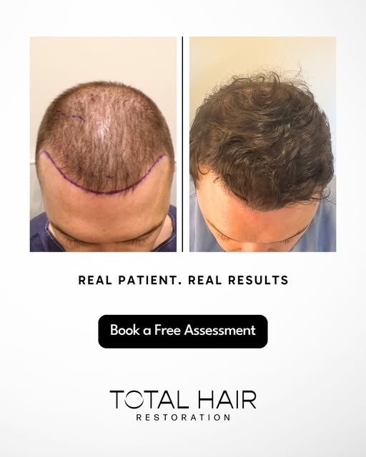 🙌 A natural-looking transformation designed to restore density, redefine the hairline and create a 