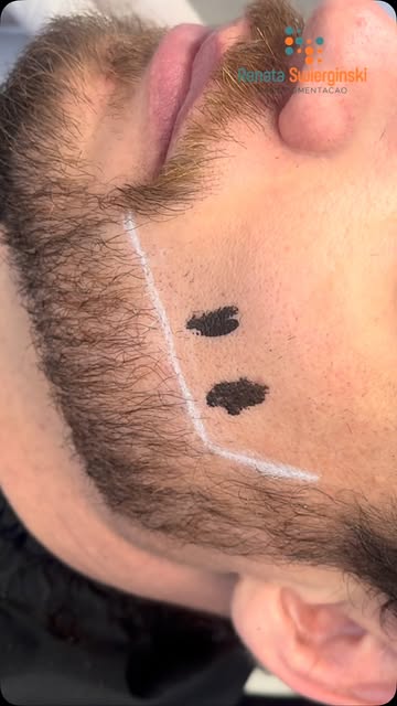 Falhas na barba? A Nanopigmentação pode mudar completamente a percepção de volume e definição. ✨

Aq