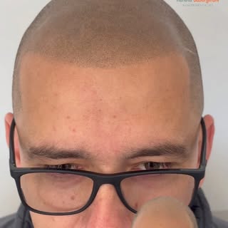 Nanopigmentação cicatrizada ✨

Resultado natural, homogêneo e perfeitamente integrado aos fios natur