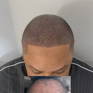 Nanopigmentação capilar fio a fio ✨

Nesse caso, trabalhamos a definição da linha frontal e o preenc