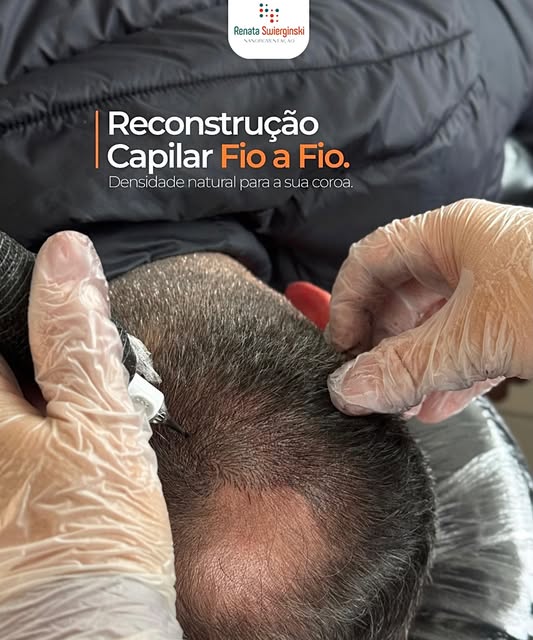 Onde faltava densidade, criamos fios. ✨

A técnica fio a fio permite preencher áreas de rarefação re