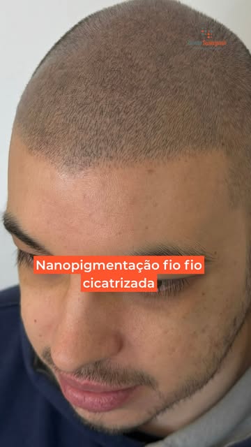 60 dias depois… e olha esses fios. 👀✨

Aqui você vê o antes, o pós-sessão e, principalmente, a micr