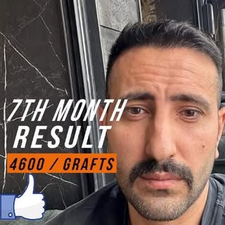 We don’t just perform hair transplants, we also create art. 🖼️ 
Hairline 

✅ Hair Transplant
✅ Bear