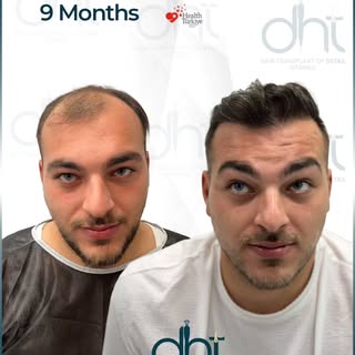 A natural hairline makes all the difference.

A total of 4,380 grafts were transplanted with a perso