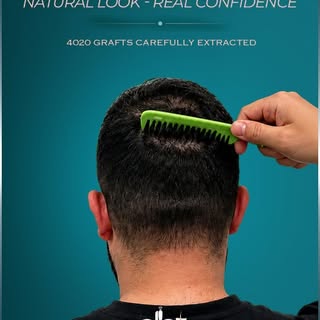 The true measure of a successful hair transplant isn't just the result on top—it's how well the dono