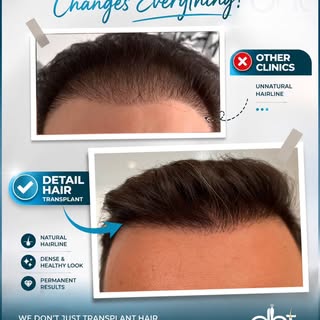 Not all hairlines are the same. Which one would you choose?

The top example shows a common issue we
