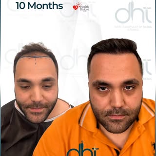 Incredible transformation in just 10 months.
4450 grafts implanted.
Step-by-step progress, real resu