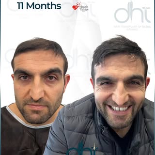 4,410 Grafts • 11-Month Transformation ✨

A natural hairline, improved density, and a balanced overa