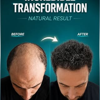 Incredible transformation in just 11 months.
5,700 grafts implanted.
Step-by-step progress, real res