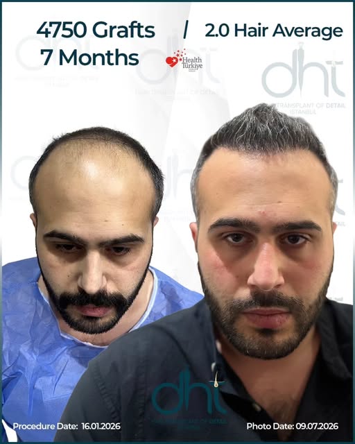 A total of 4,750 grafts were transplanted with a personalized treatment plan, focusing on creating a