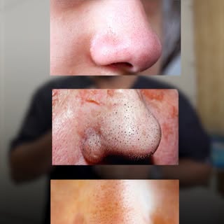 Guess the real blackhead! Can you spot the difference between true blackheads, sebaceous filaments, 