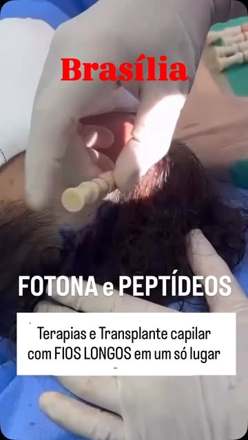 A terapia capilar evoluiu. E o transplante capilar também.

O Fotona é uma das tecnologias que repre