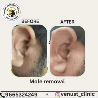 Safe & personalized mole removal treatment

📍 Venust Skin-Hair Clinic, Rasta Peth, Pune-11
📲 96653