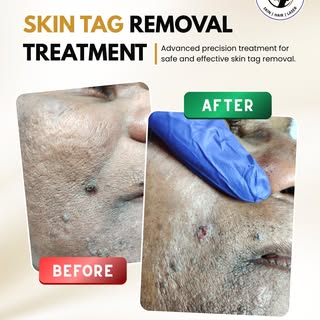 Say goodbye to unwanted skin tags with safe and effective treatment! ✨

Our advanced skin tag remova