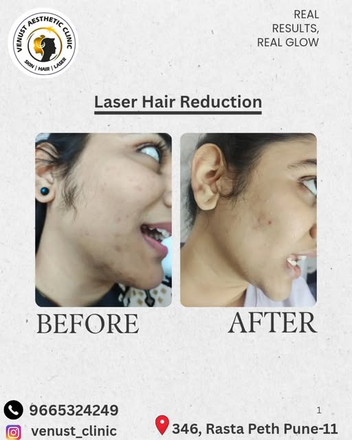 ✨ Say Goodbye to Unwanted Hair Forever! ✨

Smooth, soft, and hair-free skin is just a few sessions a