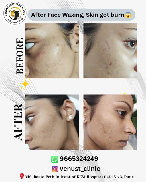 ⚠️ Face waxing caused a burn? It's time to choose a safer solution.🔴

📢Unwanted facial hair doesn'