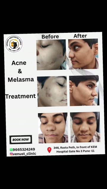 Before and After treatment result 
ACNE & MELASMA.

At Venust Skin-Hair Clinic Rasta Peth Pune-11 
.
