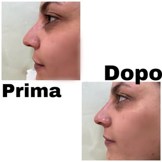 Rinofiller e correzione del mento per un viso armonico