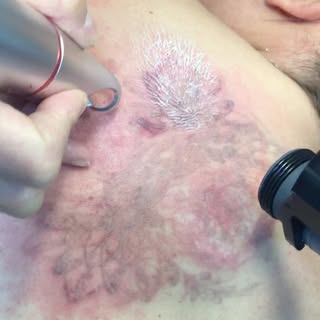 Eliminazione tatuaggio mediante laser  Q-switched