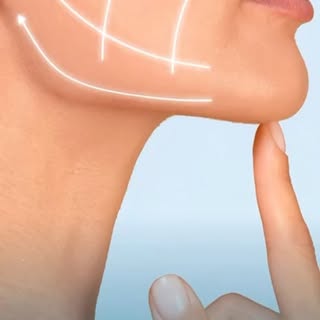 Ringiovanire in poco tempo e nel tempo ….Endolift…sistema laser che retrae i tessuti in maniera indo