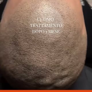 🟢Grazie alla Tricopigmentazione la calvizie ha i giorni contati ⌛️
🔴Effetto Rasato -  Effetto Dens