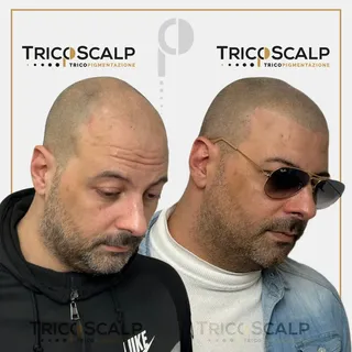 🔴Contro gli inestetismi di tutti i tipi di calvizie puoi rimediare in maniera semplice e permanente