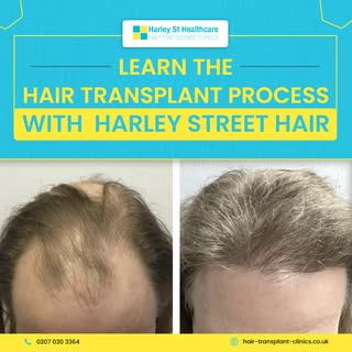 Embark on a journey of knowledge as we guide you through the intricacies of the hair transplant proc