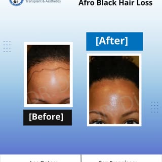 Hair loss in Afro-textured hair requires specialized techniques, and Dr. John Diep is an expert in r