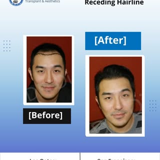 Our advanced hair transplant techniques make a fuller, natural-looking hairline possible! Witness th