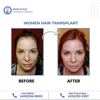 From Thinning Hair to Fuller Coverage! 
Hair loss isn't just a men's issue—our women's hair transpla