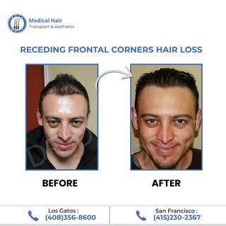 From Receding Hairline to Fuller Coverage!
This before & after showcases how advanced hair restorati