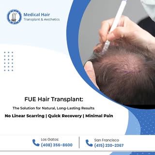 Looking for a hair transplant that leaves no linear scars and offers a quick recovery?Our FUE Hair T