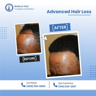 Witness the incredible results of our advanced hair loss treatments. From thinning areas to a fuller