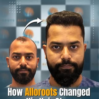 From Grade 5 baldness to full confidence — witness Mr. Anshuman Barik’s journey with AlloRoots!

🔹 