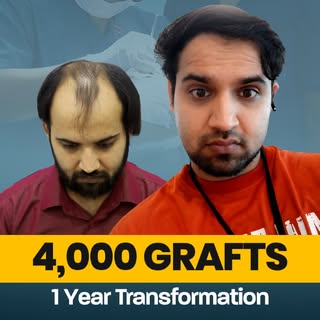 What can a hair transplant achieve in Grade 6 hair loss?

At 1 year post-procedure, this result show
